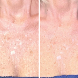 Omnilux Contour Neck & Decollete