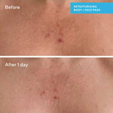 Murad Blemish Control Retexturizing Body Pads
