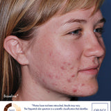Obagi CLENZIderm MD Pore Therapy