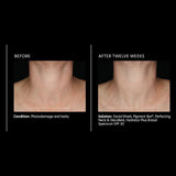 PCA Skin Perfecting Neck and Decollete
